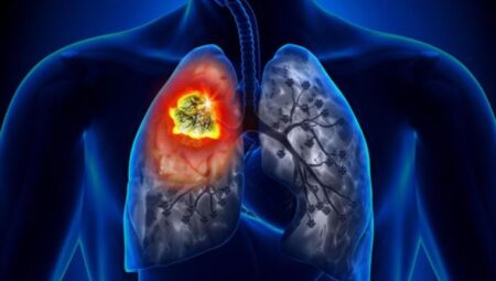 Akciğer kanseri yılda 1.8  milyon vefata neden oluyor