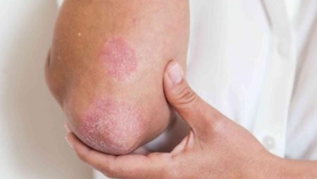 Uzmanı uyardı: Baharda alerjiye bağlı cilt hastalıklarında artış görülüyor